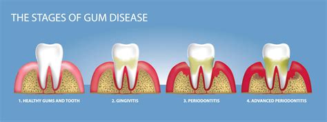 Periodontal Disease (Gum Disease) .
